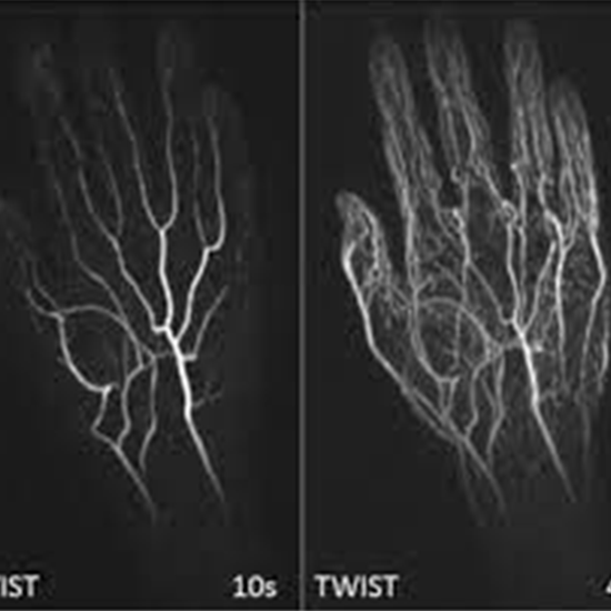 MR Angiography of Hand